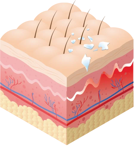 Imagen vectorial de piel con efectos de cal por agua residual sin usar el monomando OPTIMAL 360º de Hidrosalud